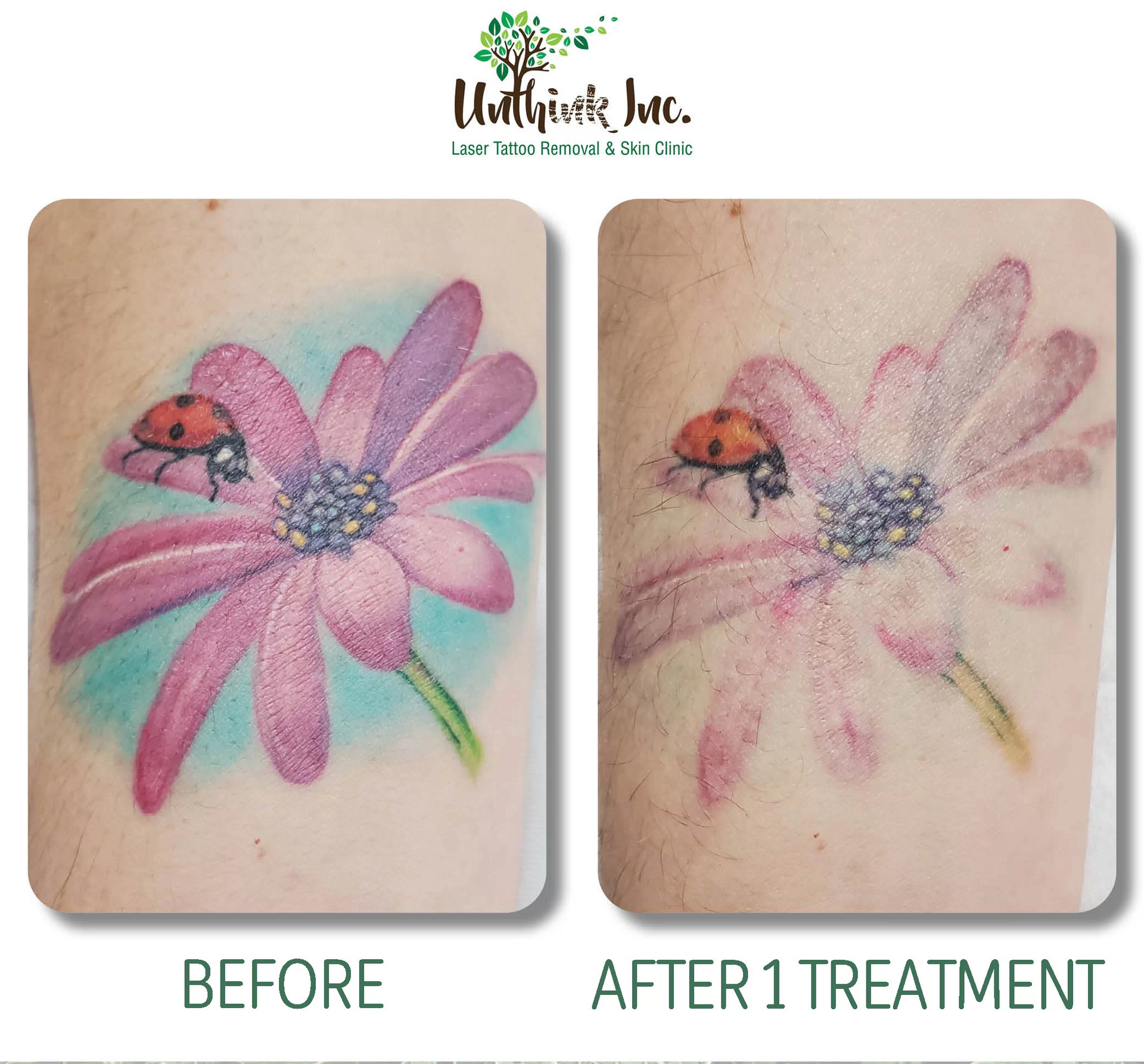 Before-and-after tattoo: pink flower with ladybug, showing faded after 1 treatment.