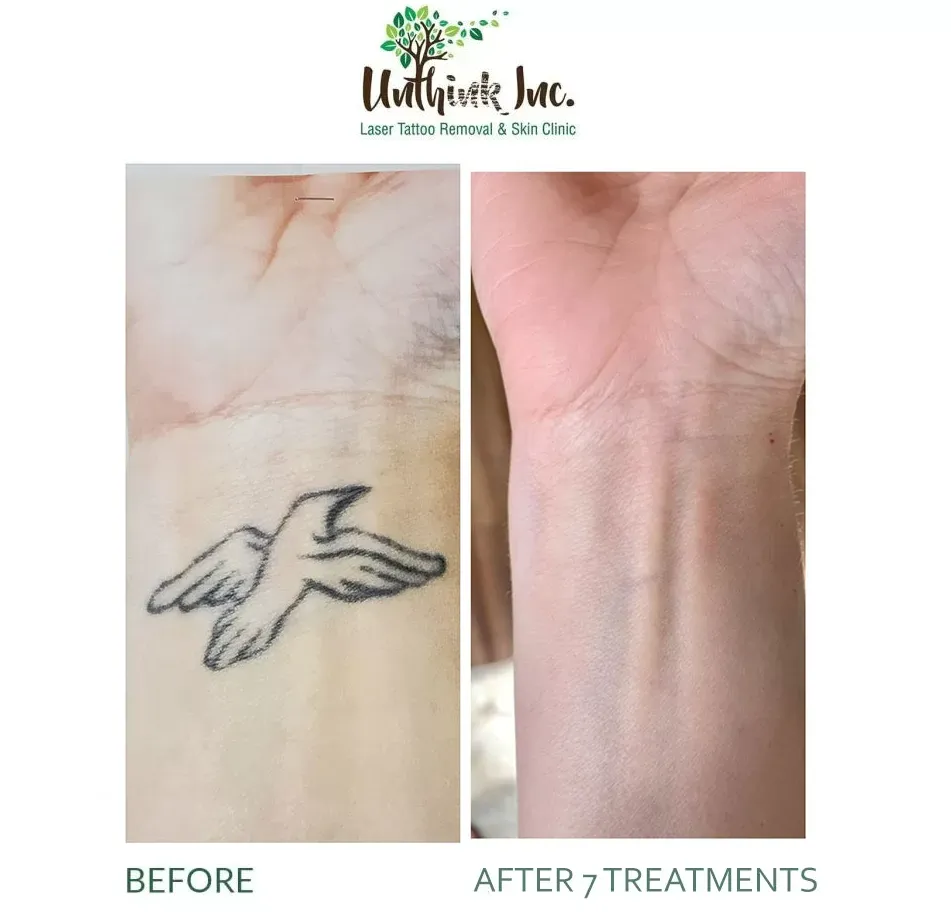 Before-and-after wrist tattoo fading: black bird tattoo nearly gone after 7 treatments.