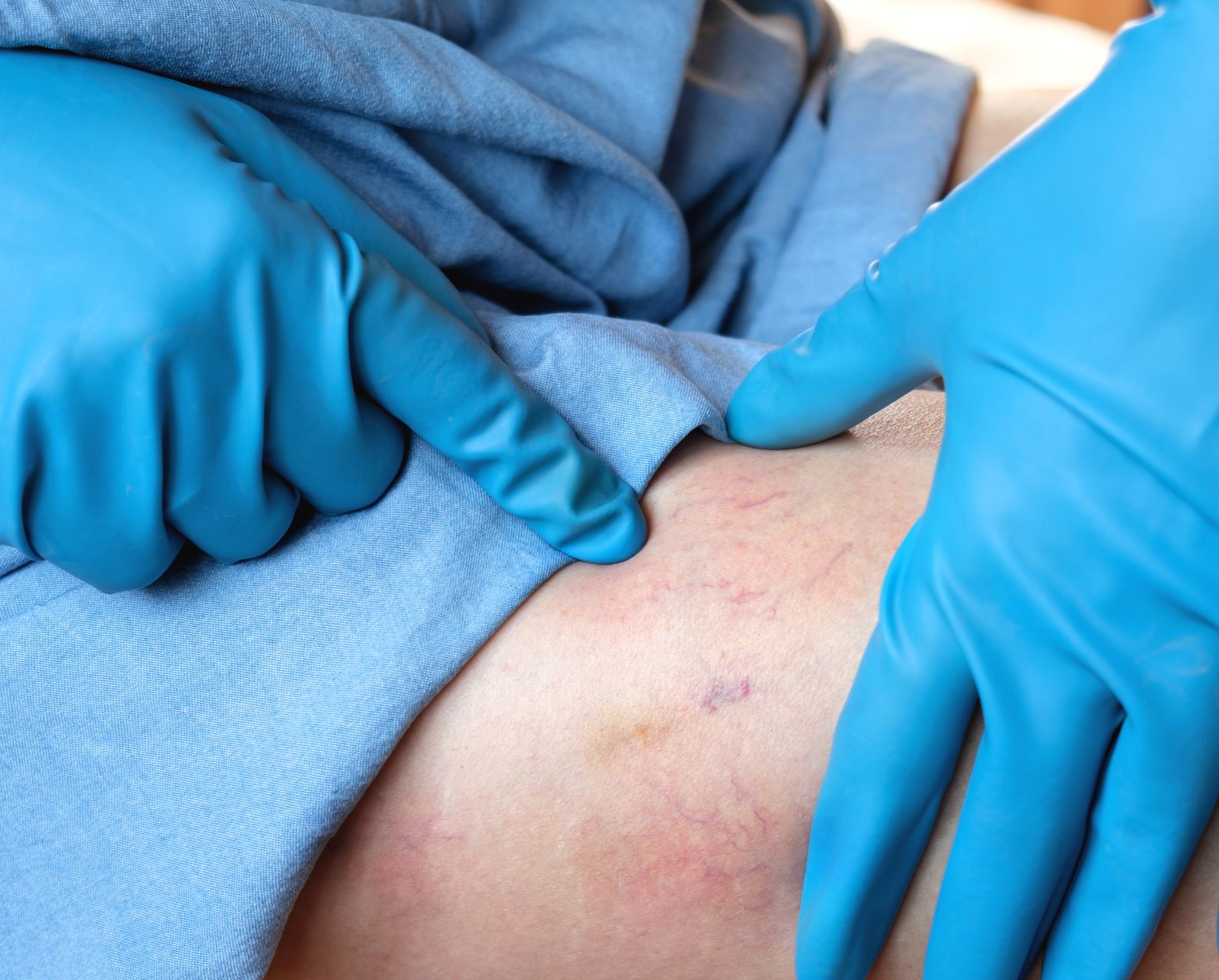 Gloved hands inspecting a patient’s reddened skin on the abdomen