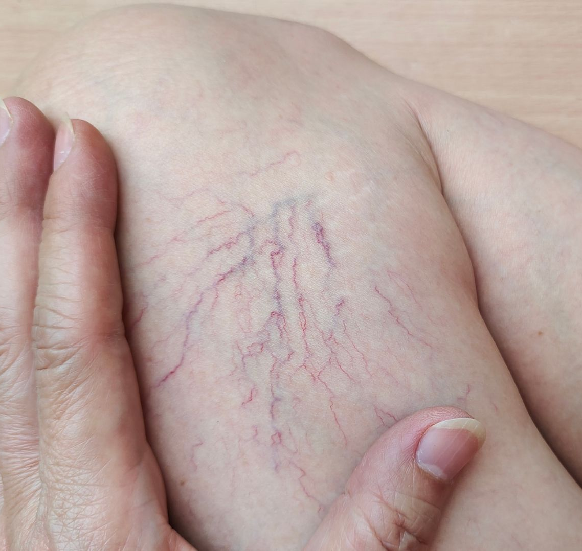 Hands gently pressing a leg with visible purple stretch marks on pale skin
