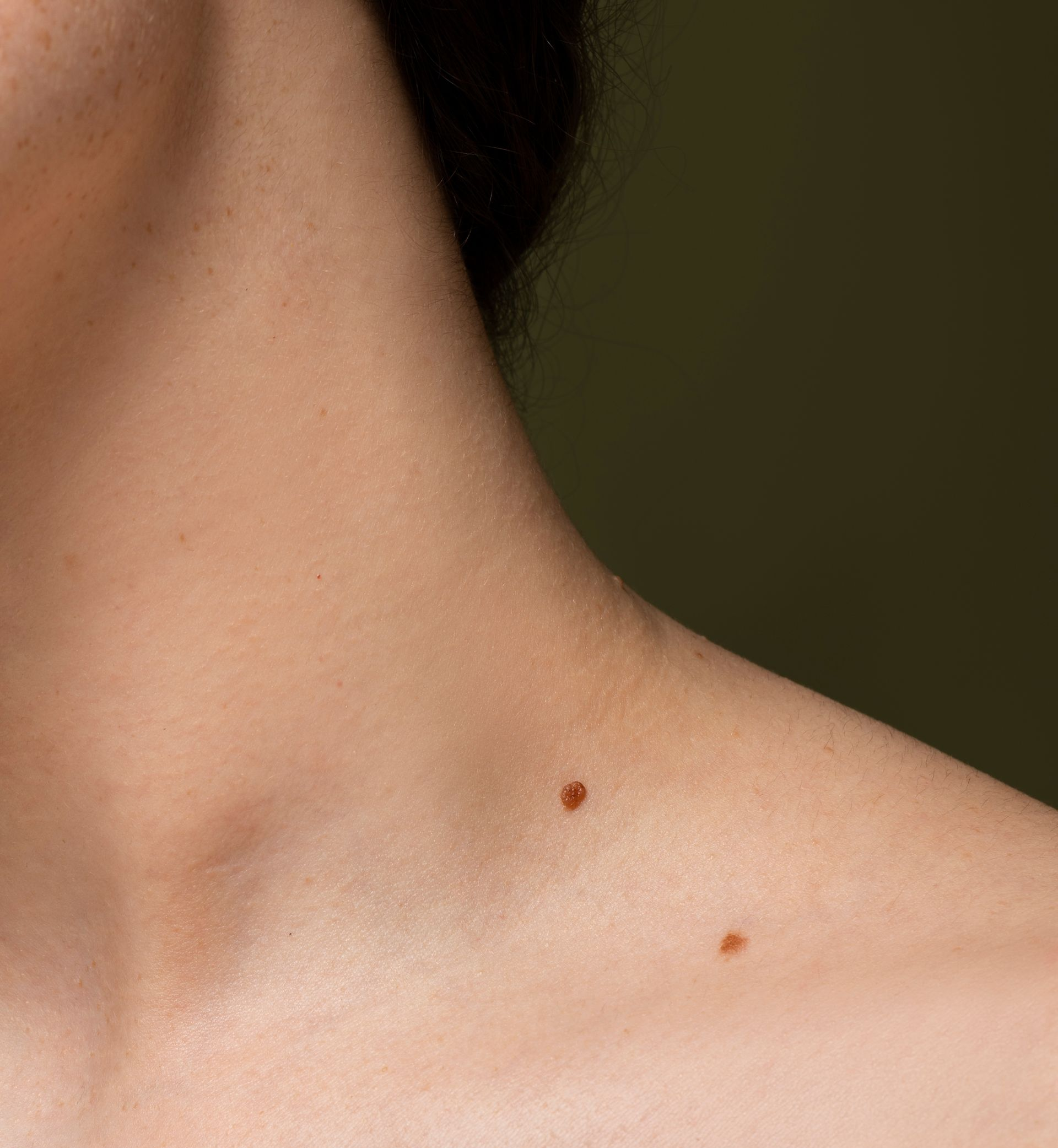 Close-up of a neck and shoulder with two small brown moles on pale skin