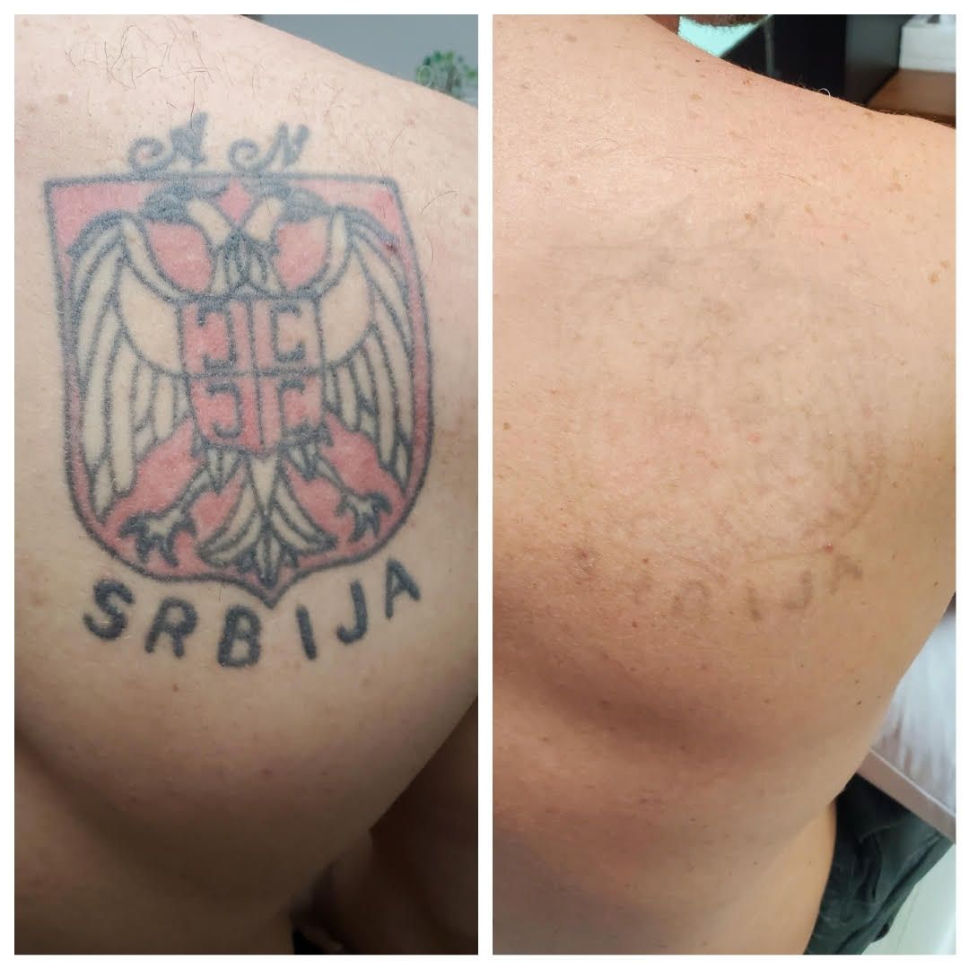 Side-by-side close-up of a Serbian coat-of-arms tattoo before and after removal on skin.