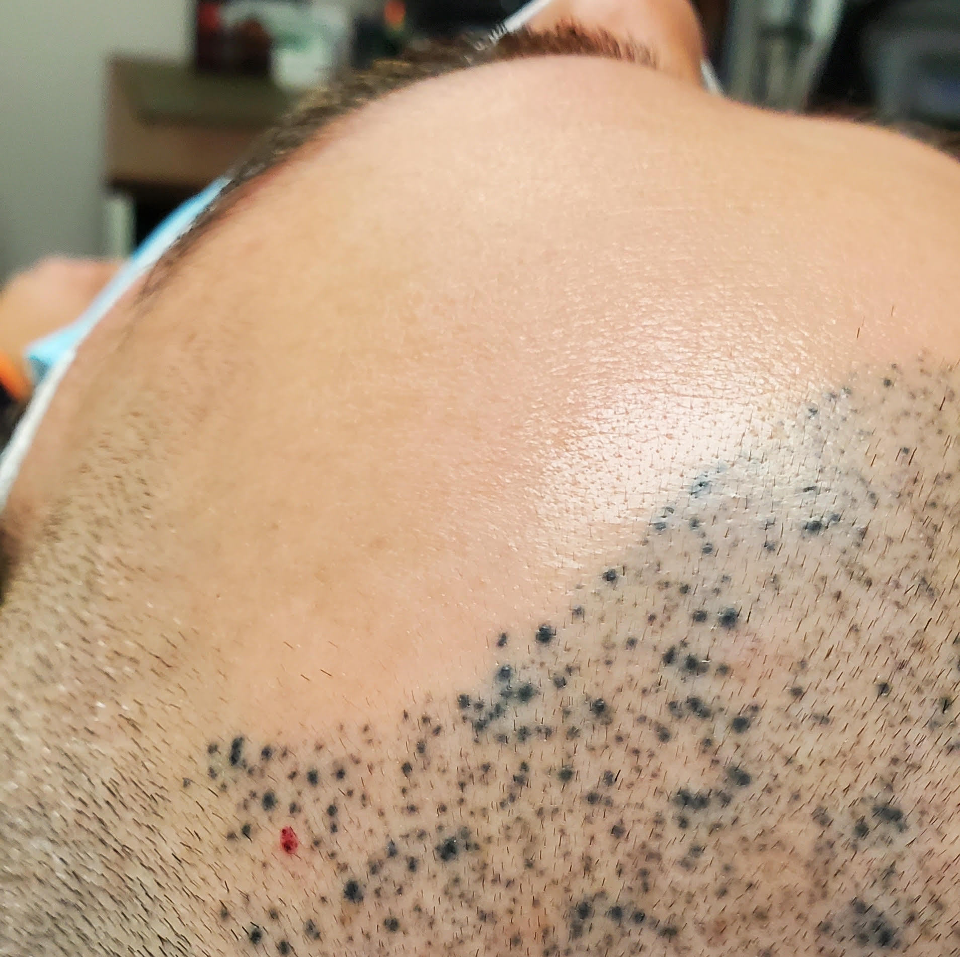 Close-up of a bald scalp with scattered dark spots near the forehead