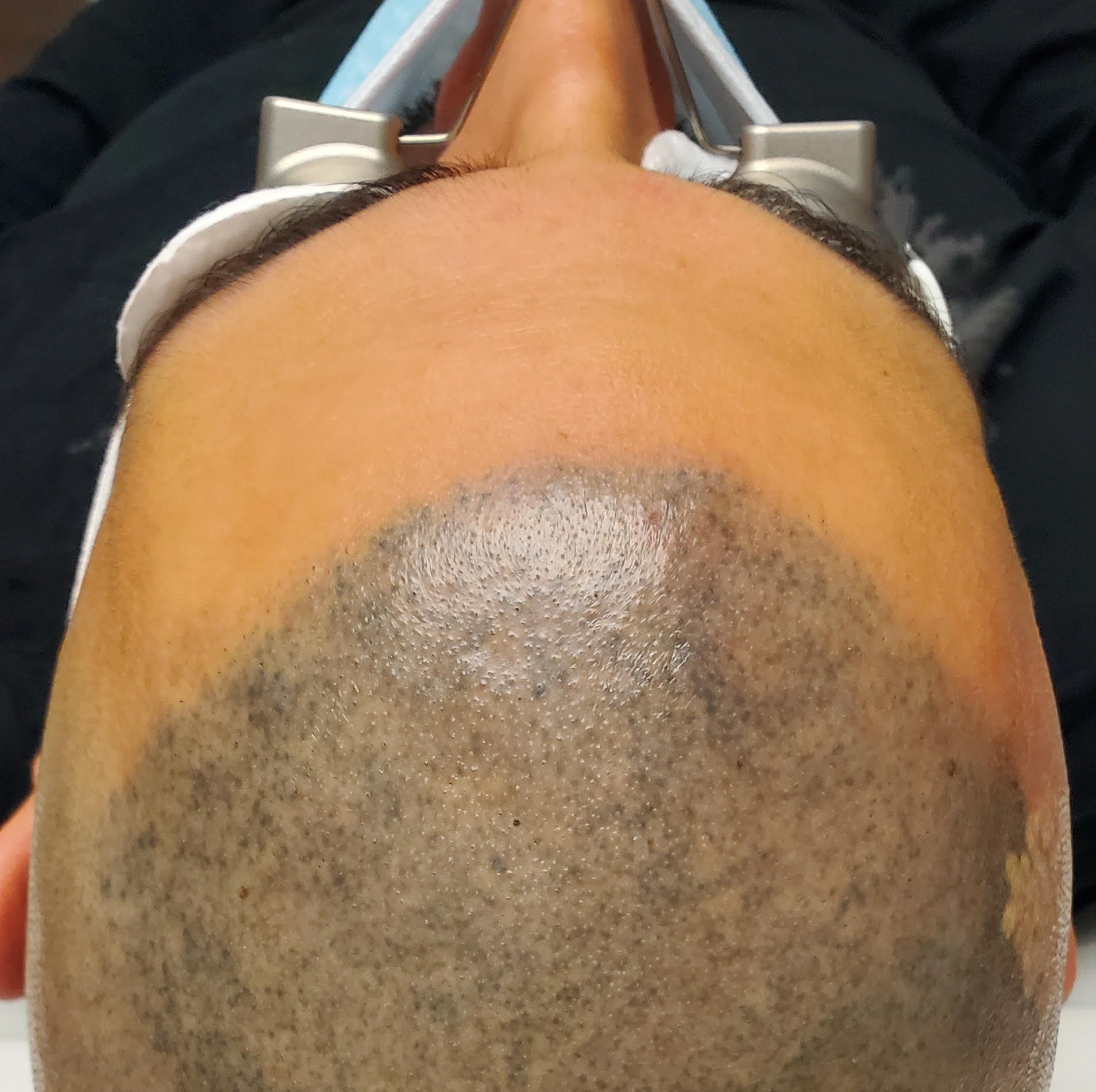 Close-up of a bald scalp with a shiny central patch and visible skin discoloration.