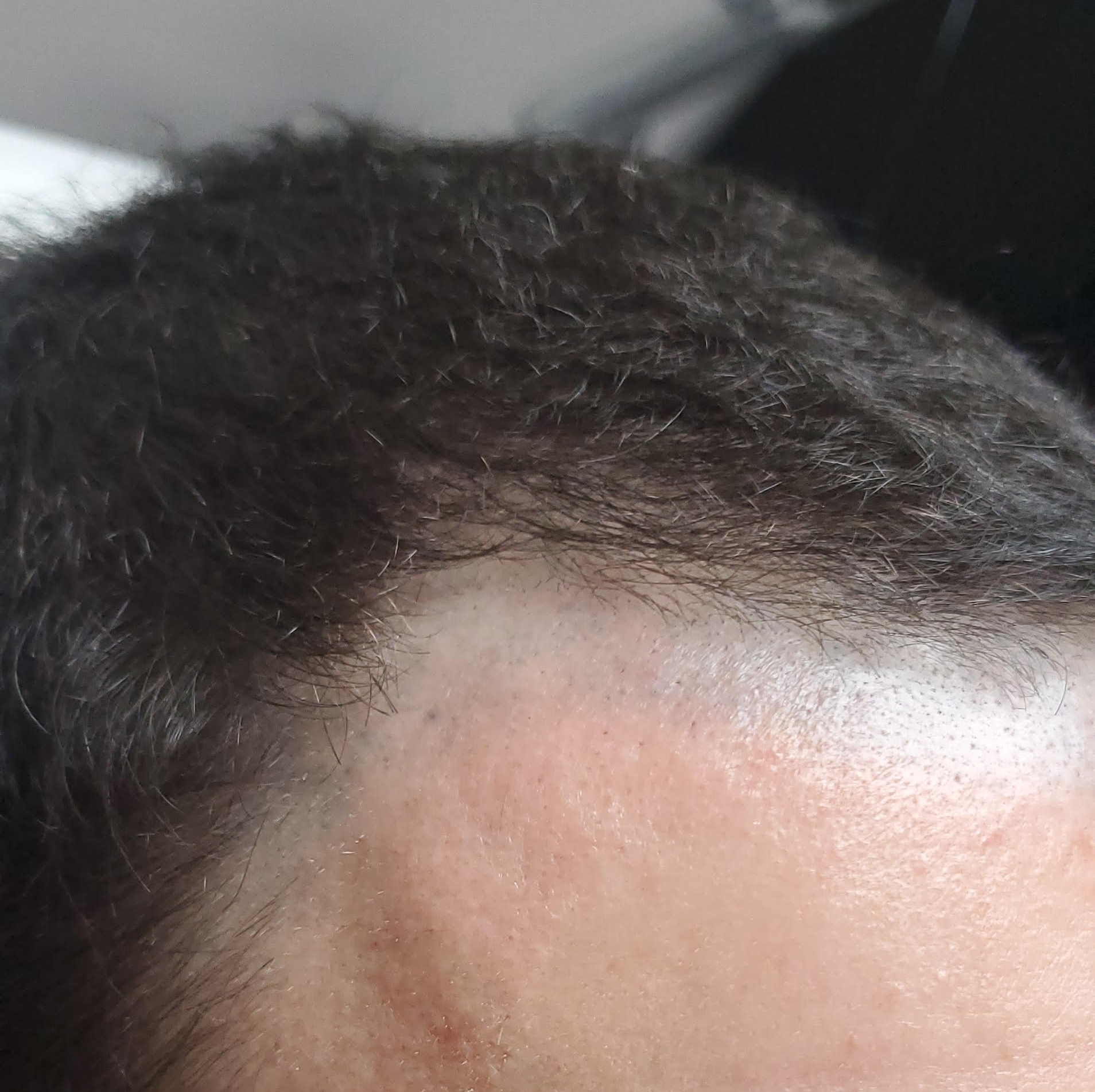 Close-up of a person’s hairline and forehead with short dark hair