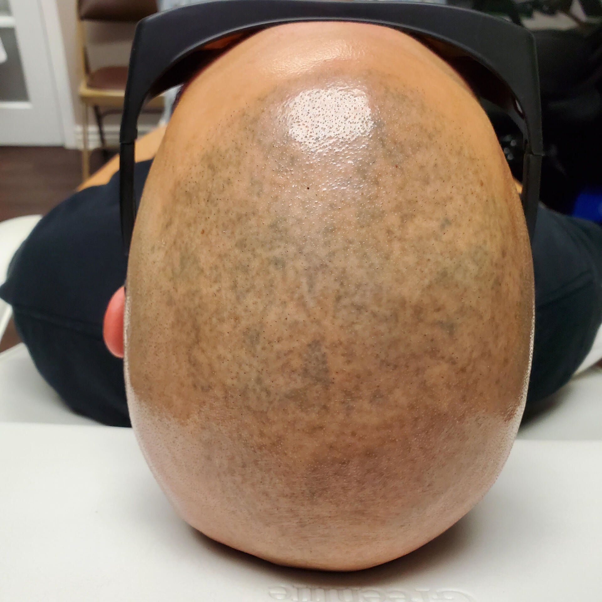 Top view of a bald scalp resting on a black neck support device on a white surface