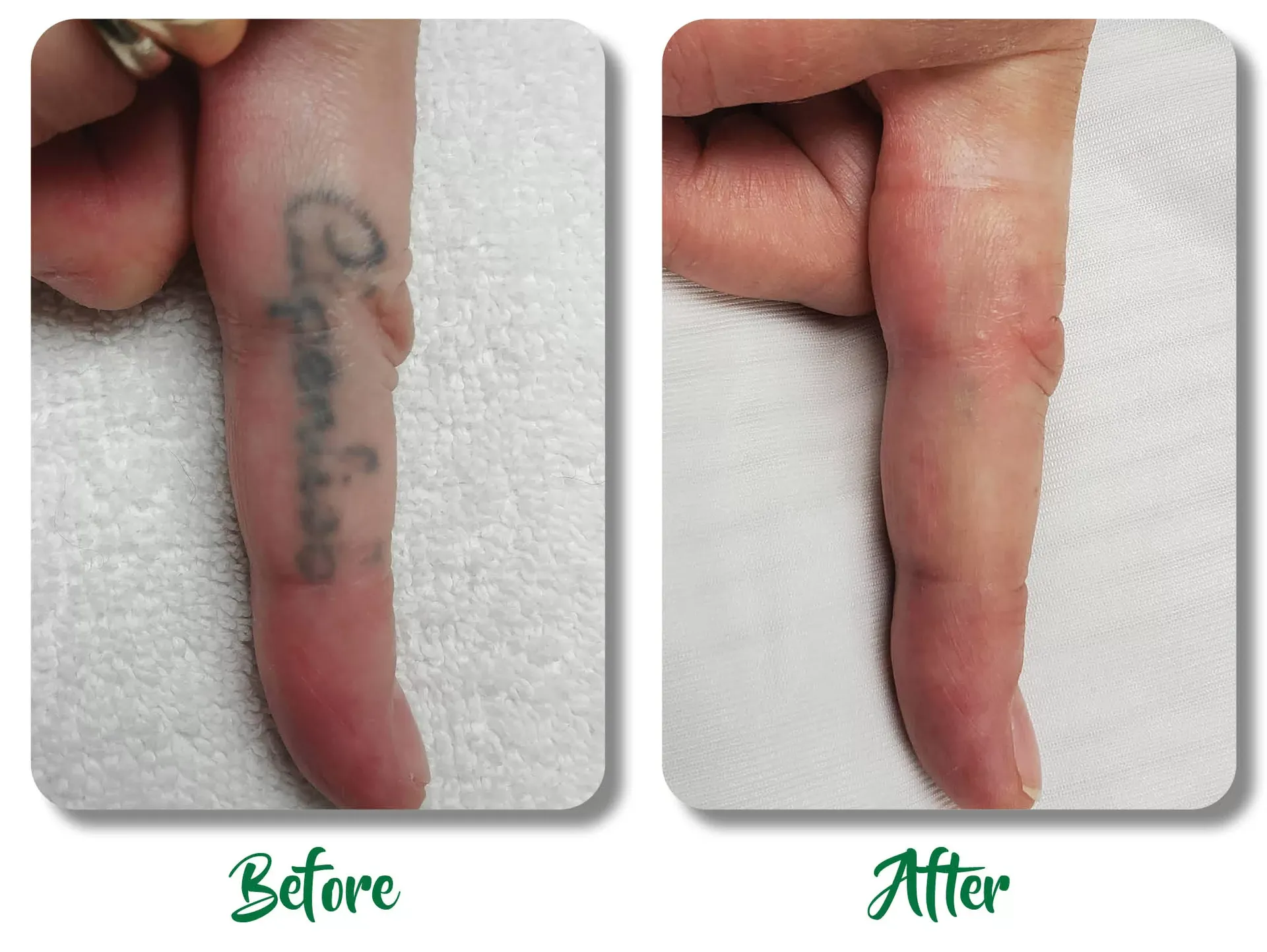 Before-and-after close-up of a finger, showing a tattoo on one side and a healed, smoother finger on the other.