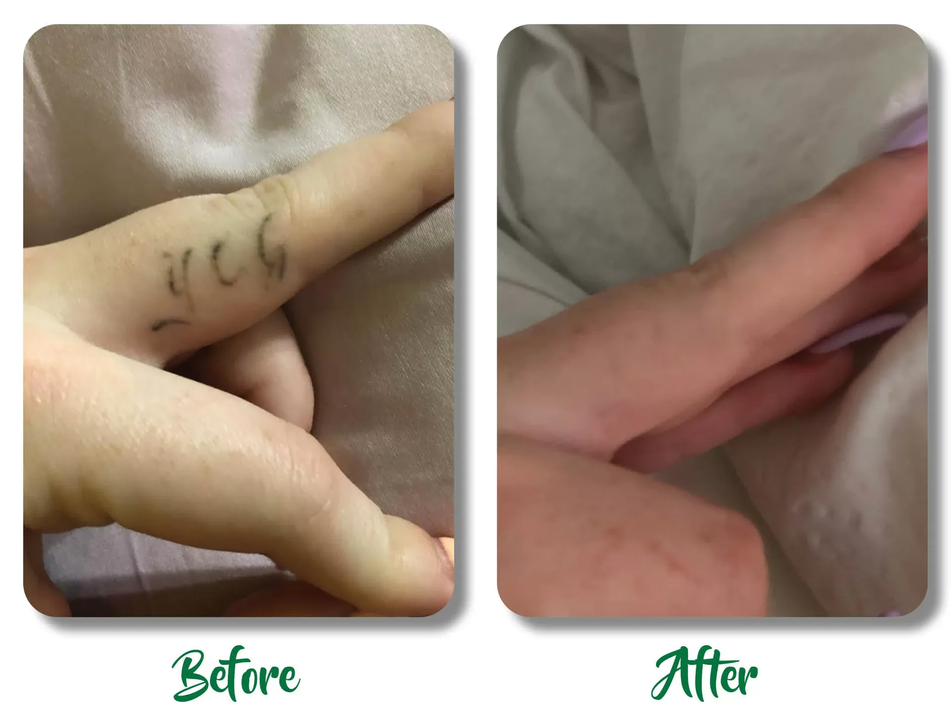 Before-and-after close-up of a finger tattoo removed, with faded ink visible in the after image