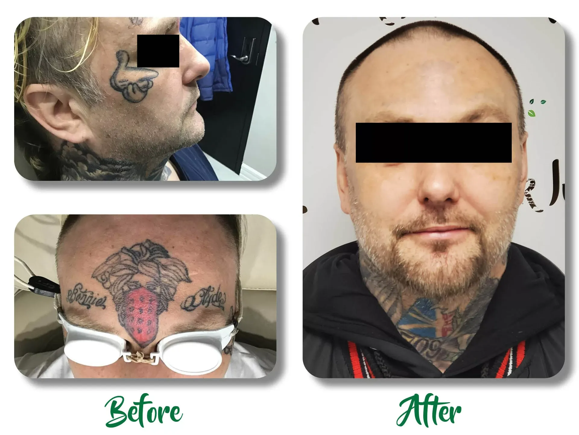 Before-and-after collage of face and neck tattoos, with the same person shown in profile and front view.