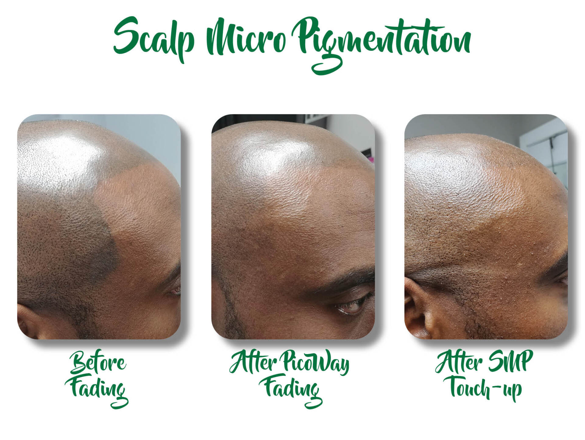 Scalp micro pigmentation progress: before, after healing, and after scalp touch-up close-ups.