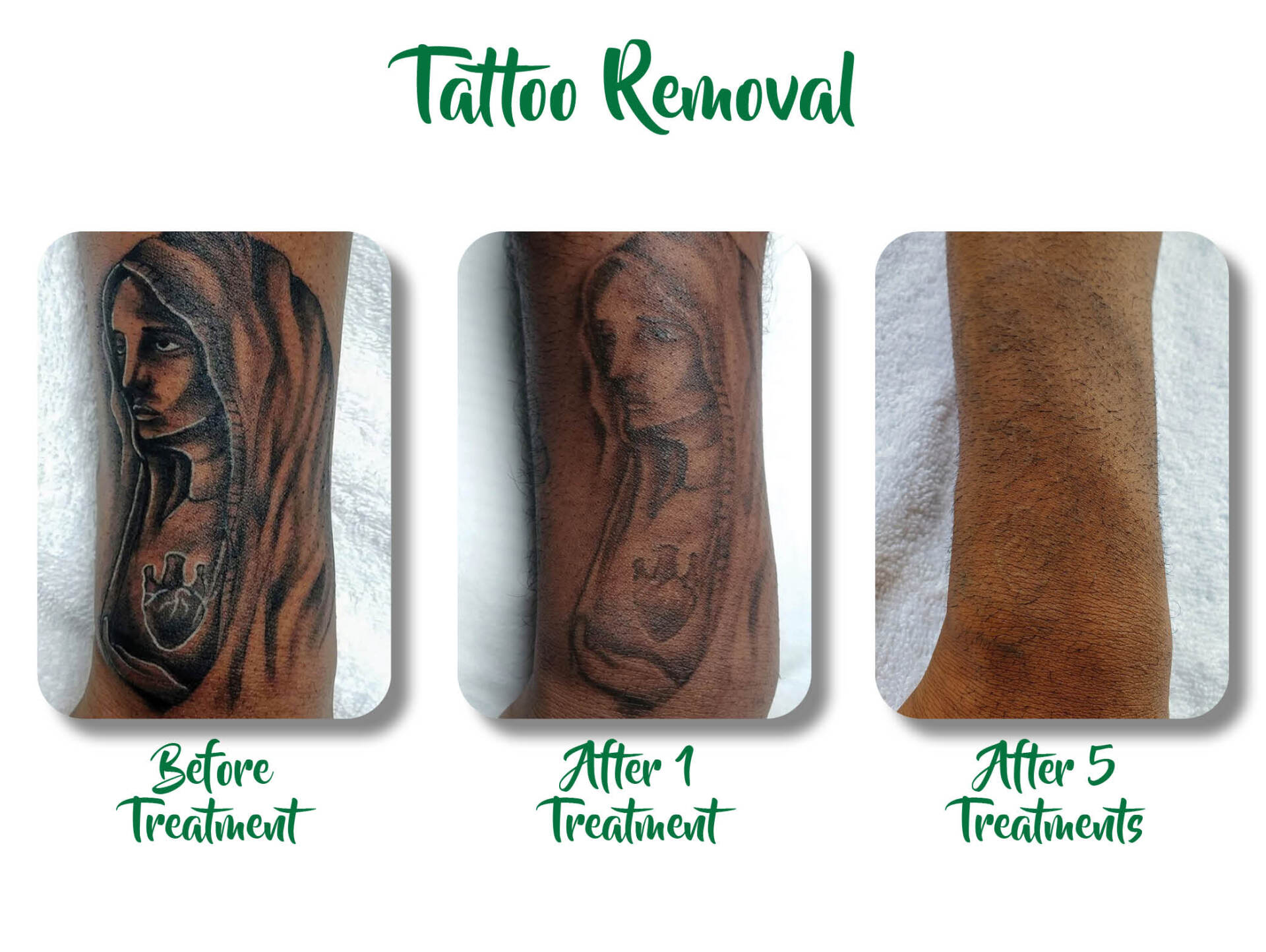 Tattoo removal comparison showing before treatment, after 1 treatment, and after 5 treatments on an arm