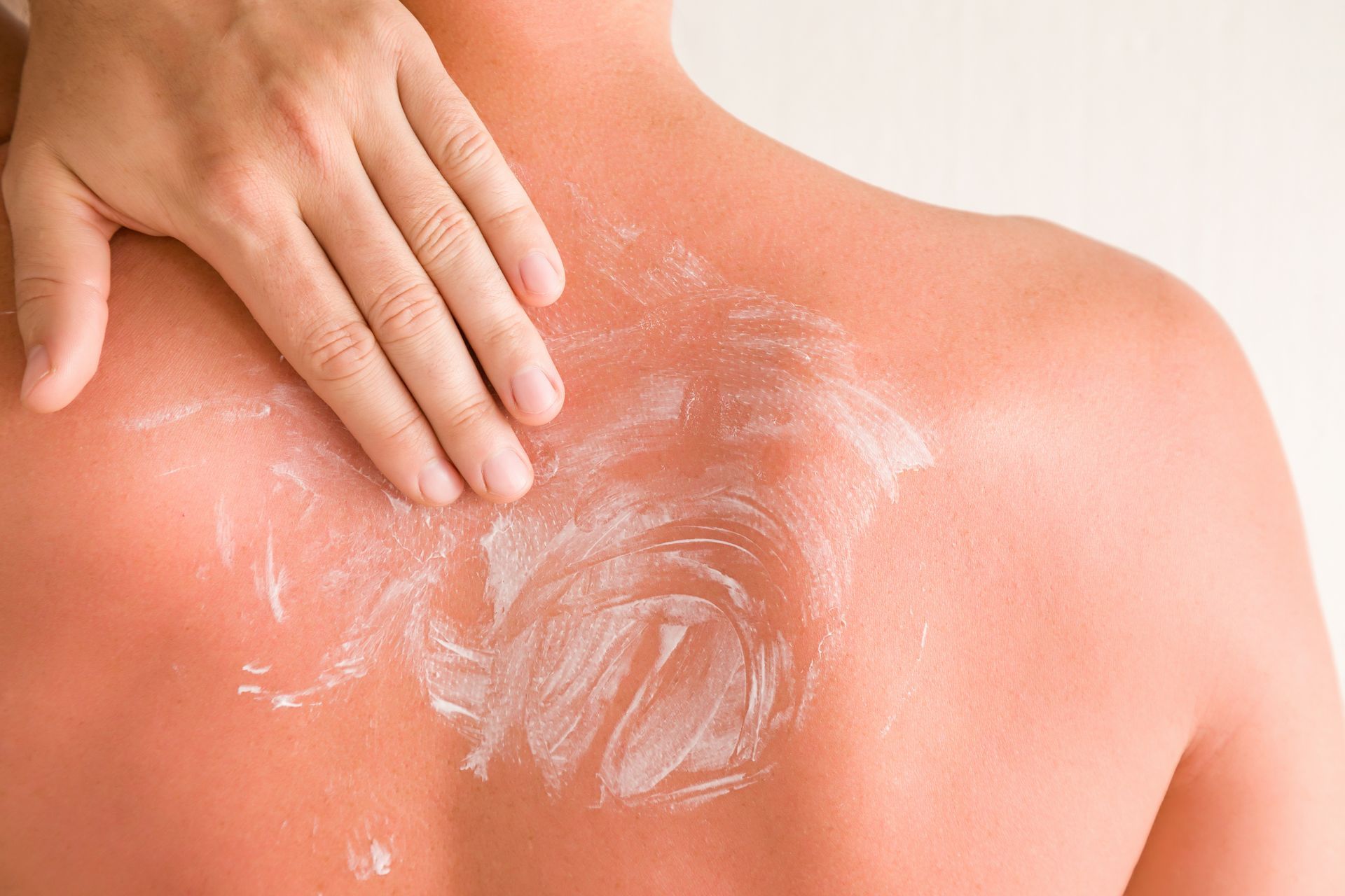 A hand applying white lotion to a person’s sun-reddened back.