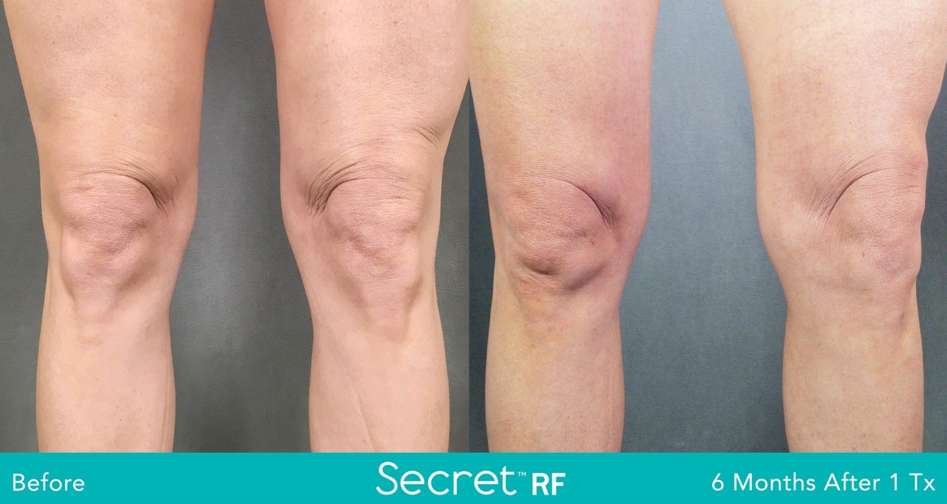 A before and after photo of a person 's knee