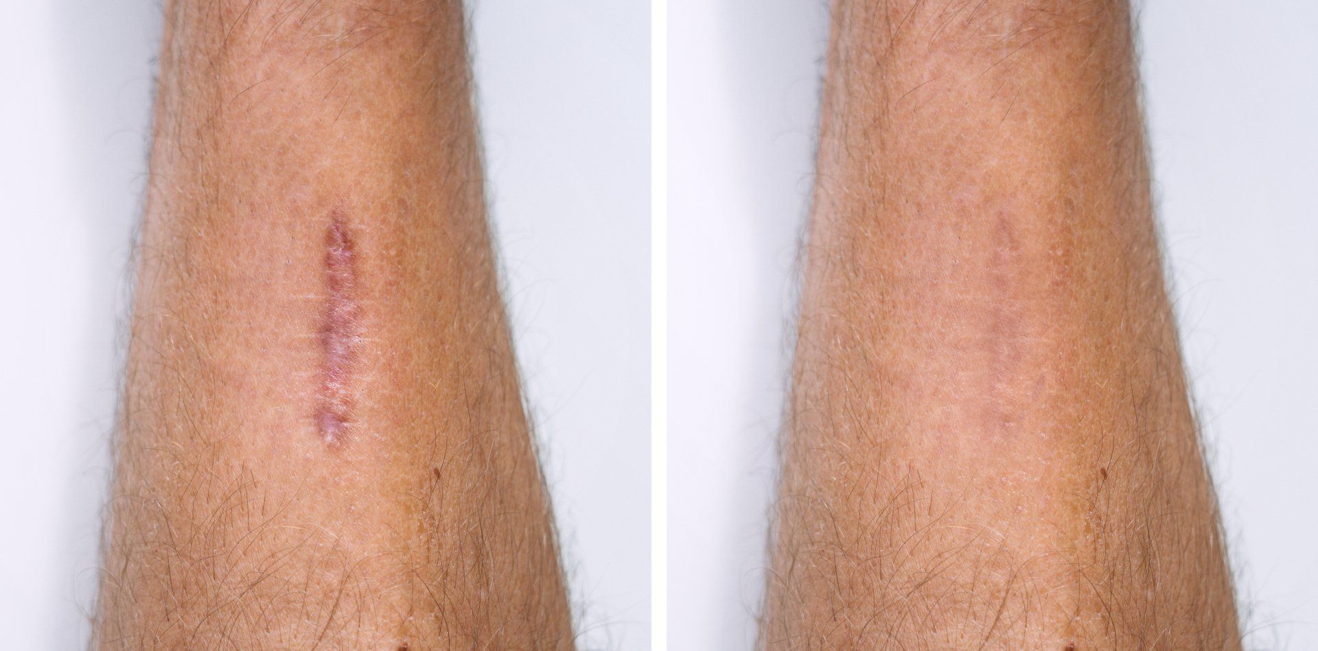 A before and after picture of a person 's leg with a scar.