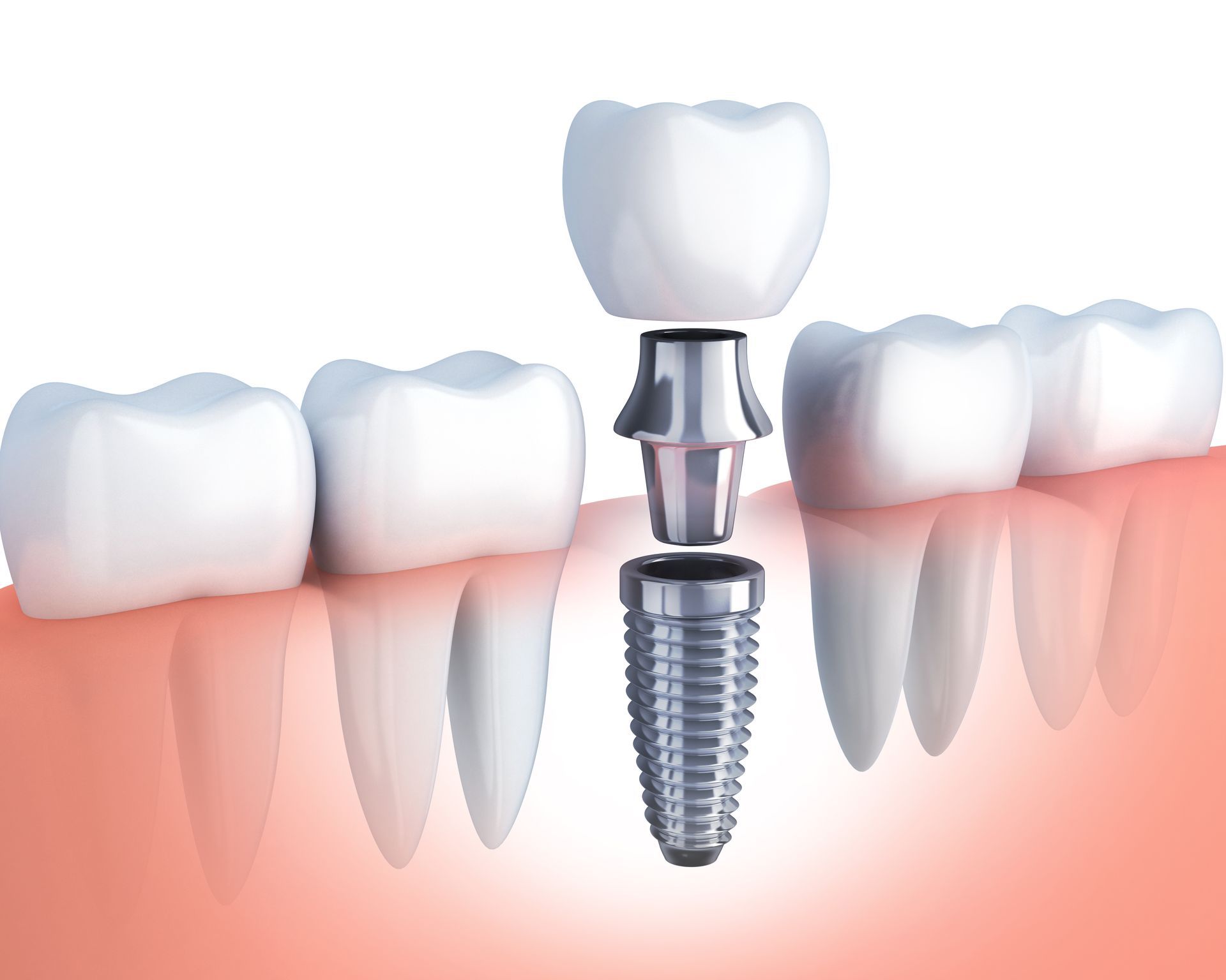 ALL-ON-4 IMPLANTS