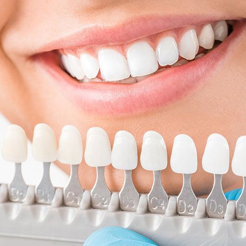PORCELAIN VENEERS