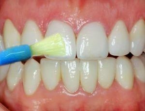 FLUORIDE TREATMENTS