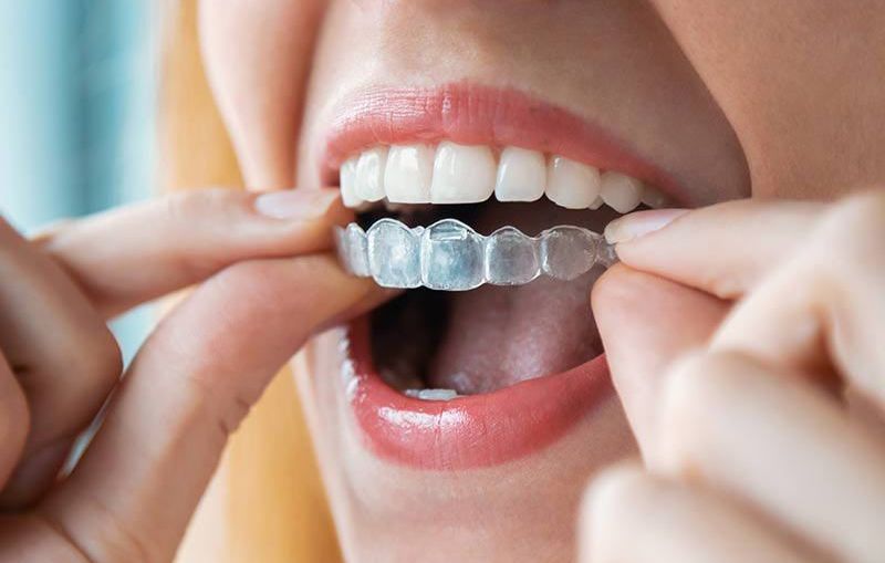 INVISALIGN®