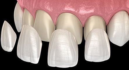 PORCELAIN VENEERS
