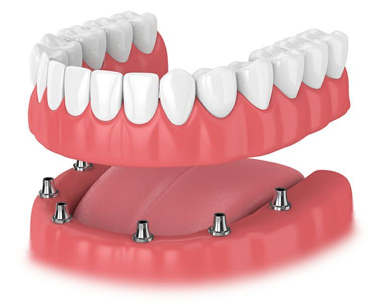 IMPLANT-SECURED DENTURES