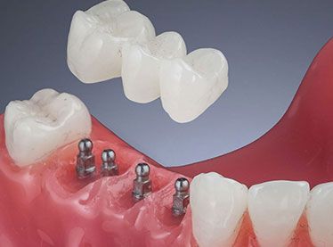MINI DENTAL IMPLANTS