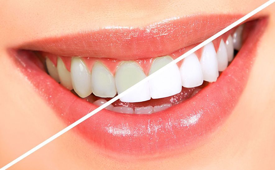TEETH WHITENING