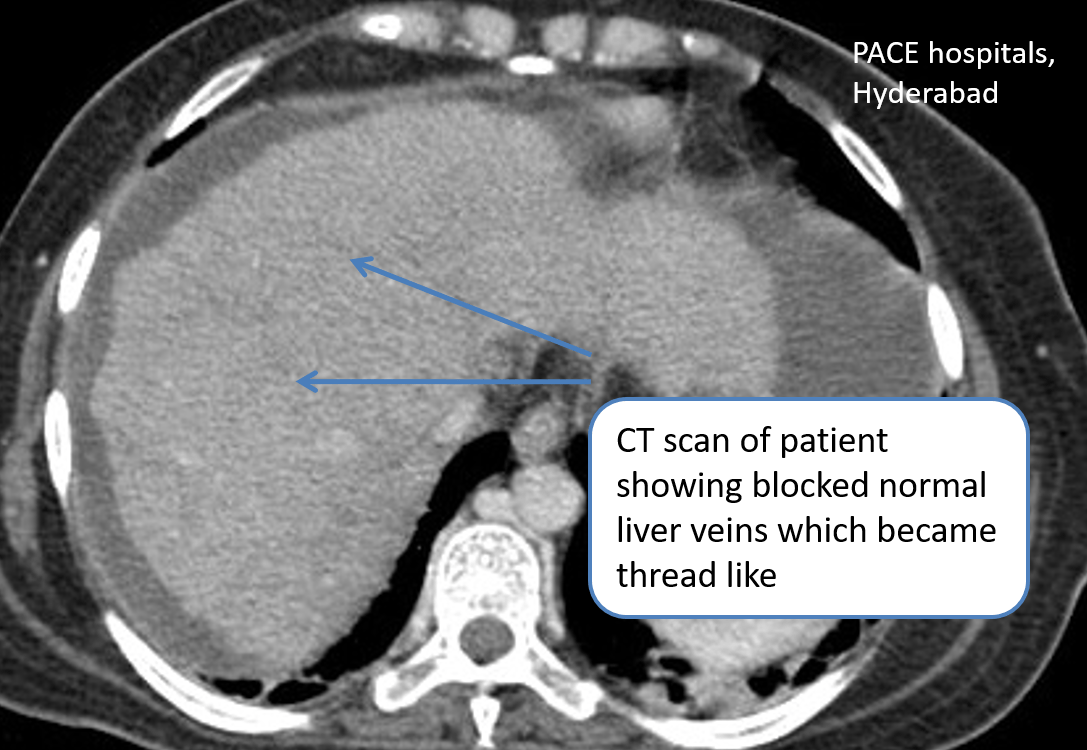 BuddChiari syndrome (Hepatic Vein Thrombosis) DIPS procedure
