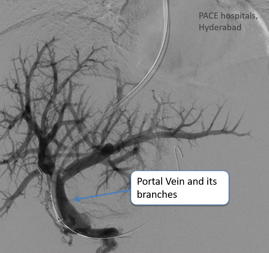 BuddChiari syndrome (Hepatic Vein Thrombosis) DIPS procedure