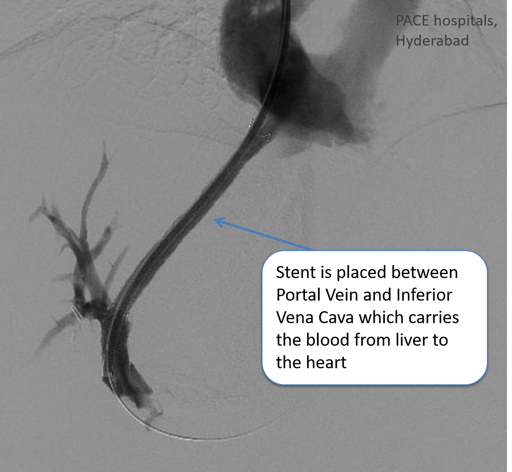 BuddChiari syndrome (Hepatic Vein Thrombosis) DIPS procedure