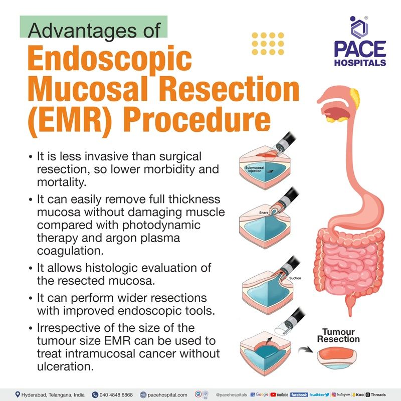 Endoscopic Mucosal Resection in Hyderabad, India Indications & Cost