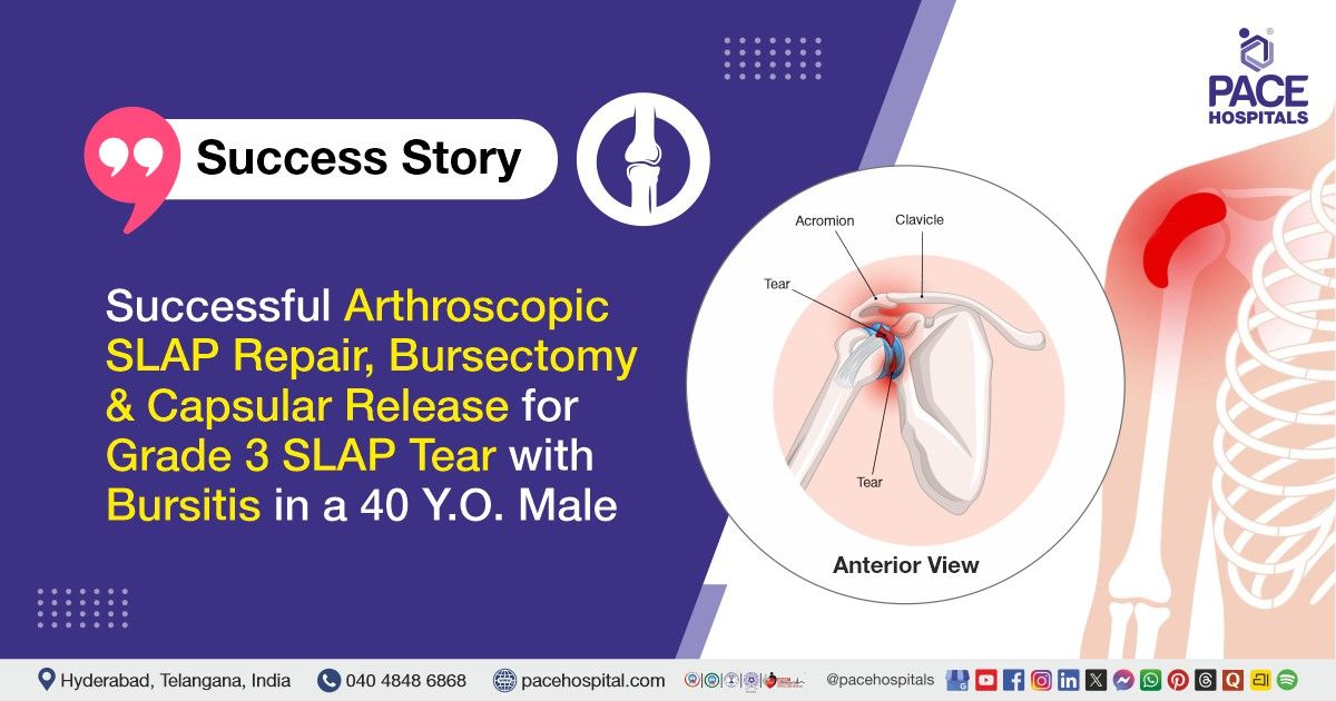 Arthroscopic SLAP Repair & Bursectomy for SLAP Tear with Bursitis