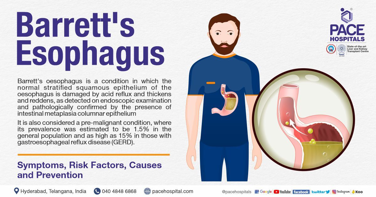 Barrett s Esophagus Symptoms Causes Types And 60 OFF