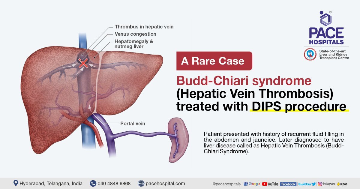 Budd-chiari syndrome (hepatic vein thrombosis) - dips procedure