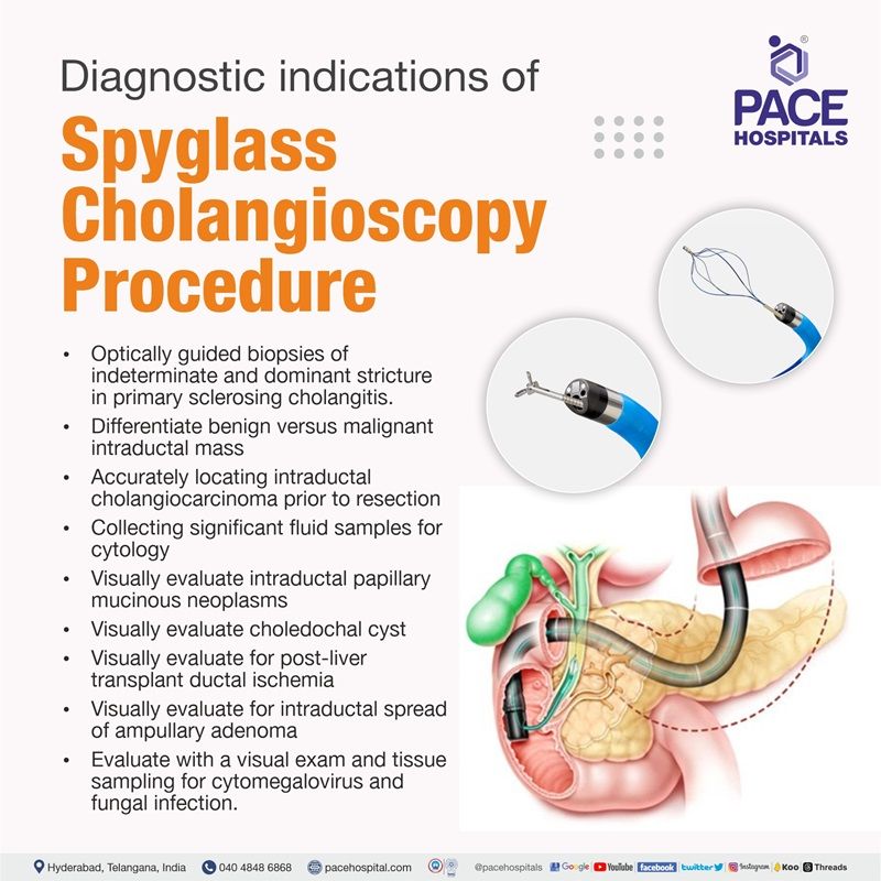 Spyglass Cholangioscopy in Hyderabad, India Indications & Cost