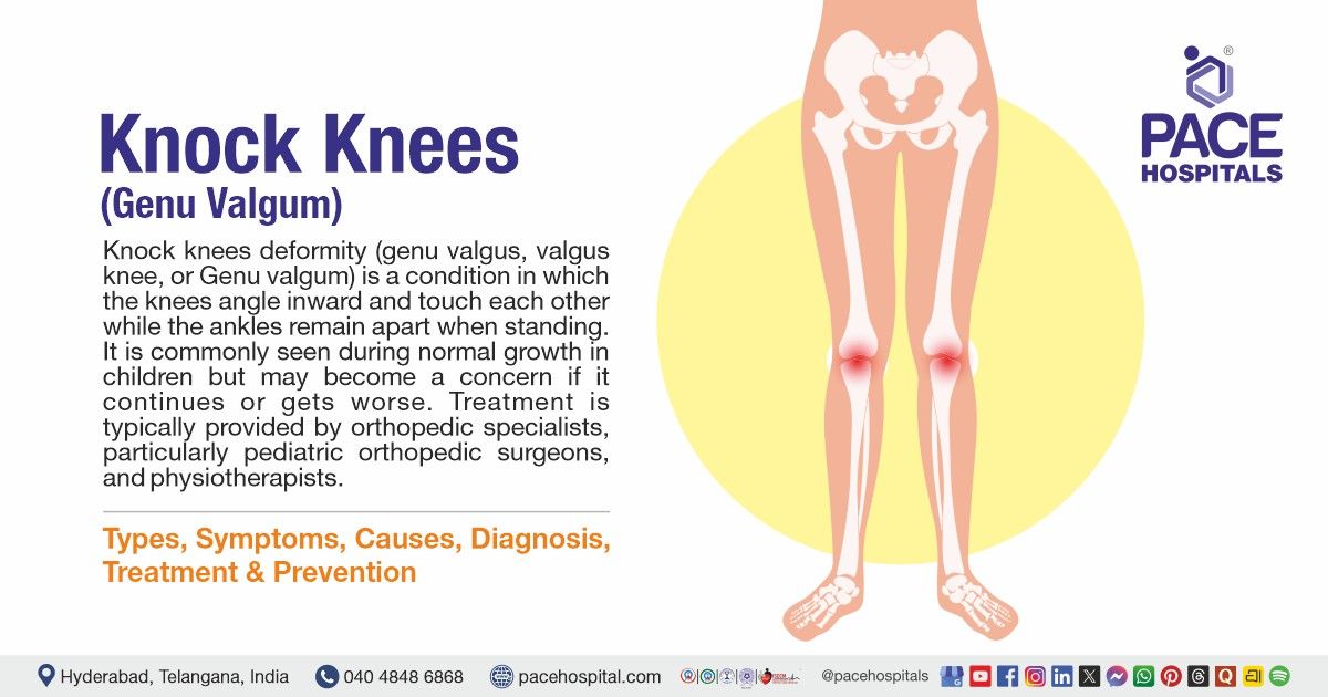 Knock Knees (Genu Valgum) Types, Symptoms, Causes & Treatment — free download