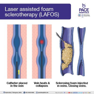 Best Hospital for Varicose Veins Treatment in Hyderabad- Surgery, Cost
