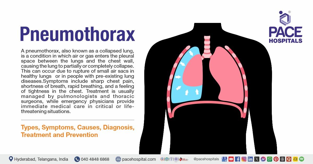 pneumothorax vape Reporting of pneumothorax in association with vaping devices and electronic  cigarettes