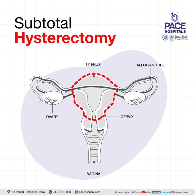 Hysterectomy Surgery in Hyderabad Indications, Side effects & Cost