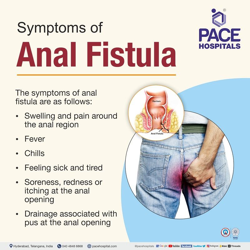 Anal fistula - Symptoms, Causes, Types, Complications, Prevention