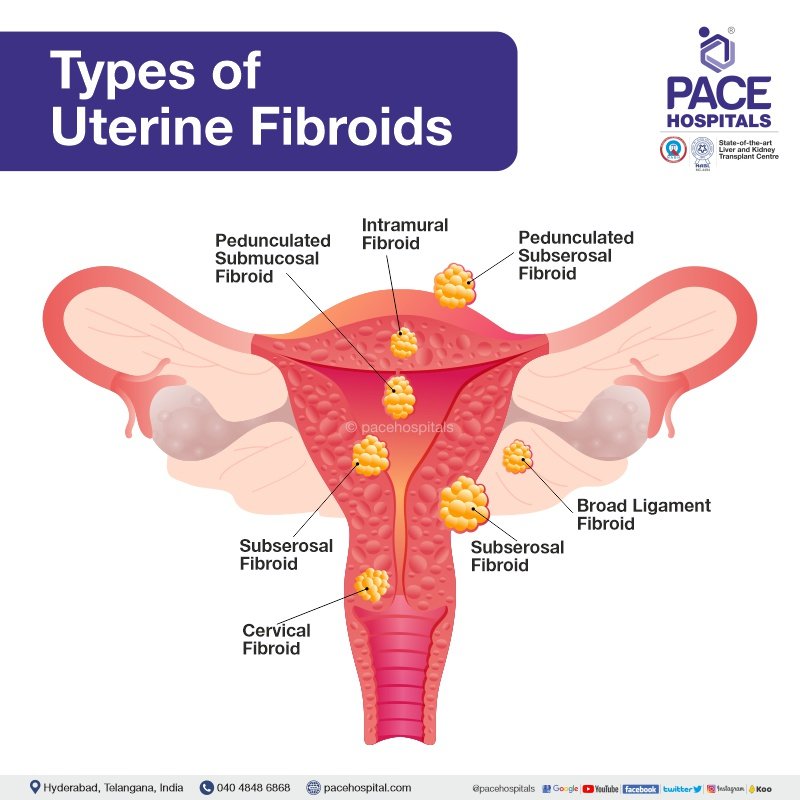 Uterine Fibroids Symptoms, Causes, Complications and Prevention