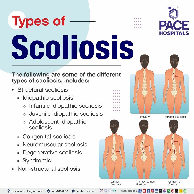 Scoliosis: Symptoms, Causes, Types & Treatment