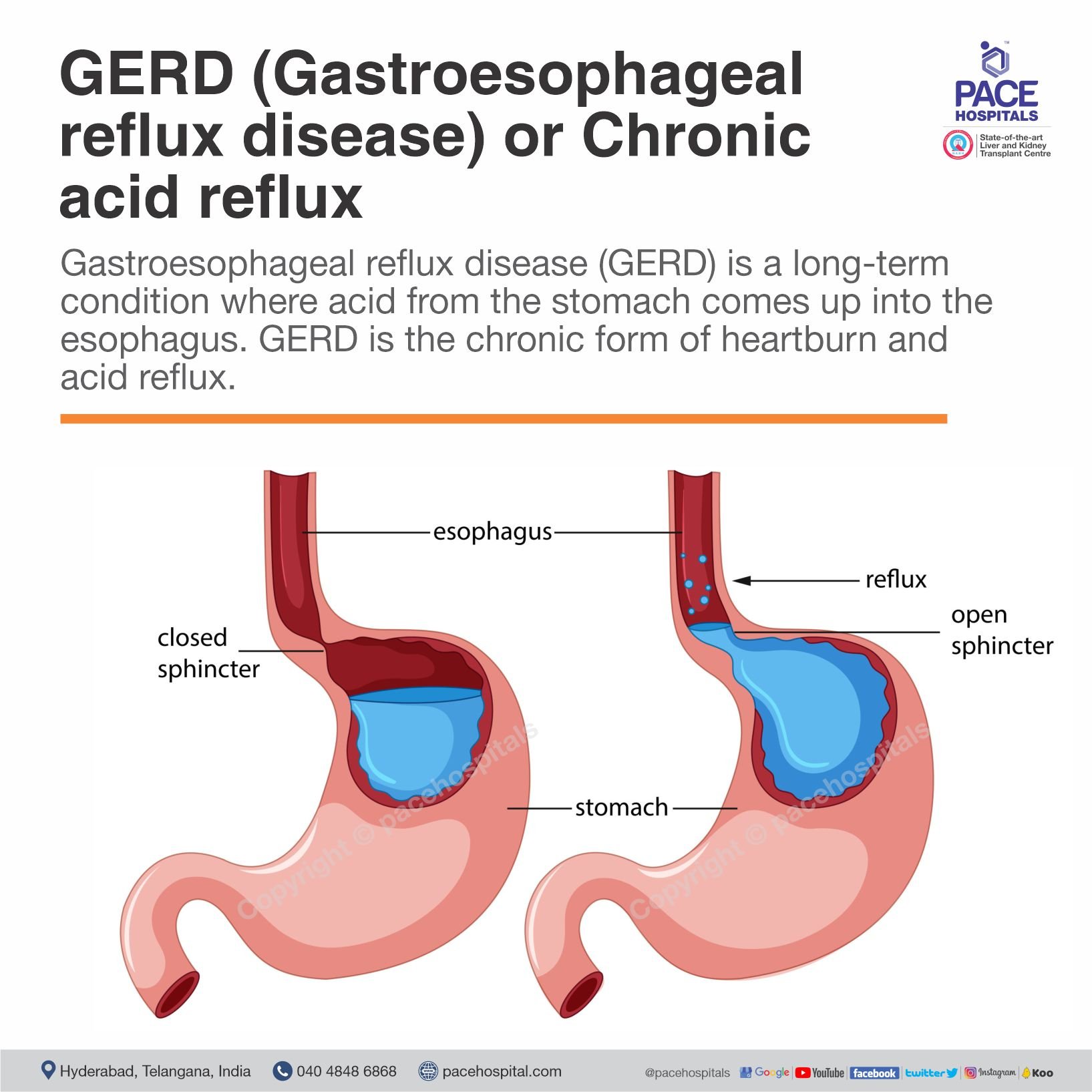 Does Ranch Dressing Cause Acid Reflux?  The Science Revealed - 5pi86xh