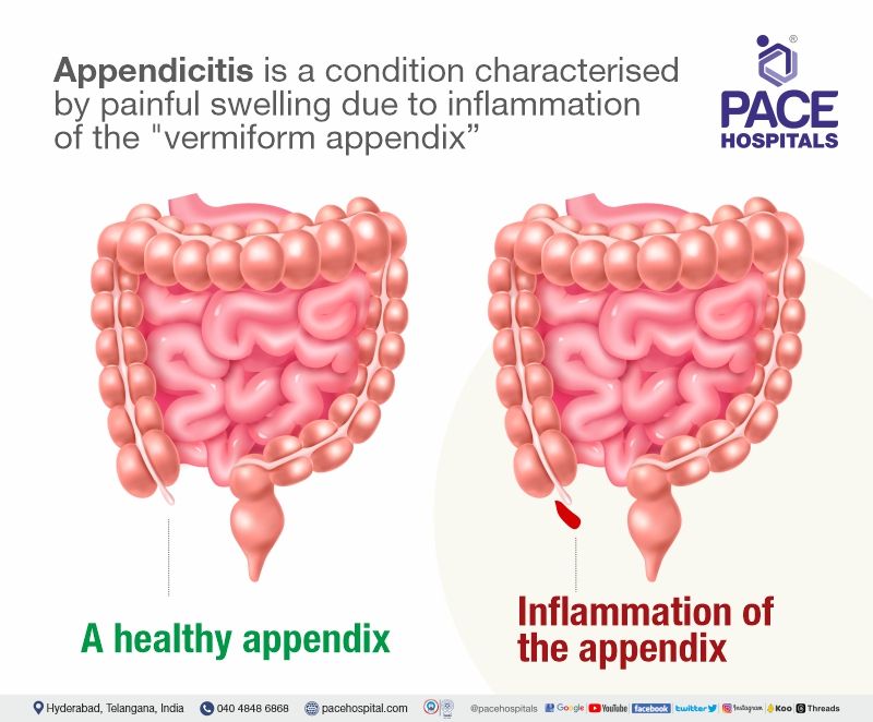Appendicitis Symptoms, Types, Causes, Complications, Prevention
