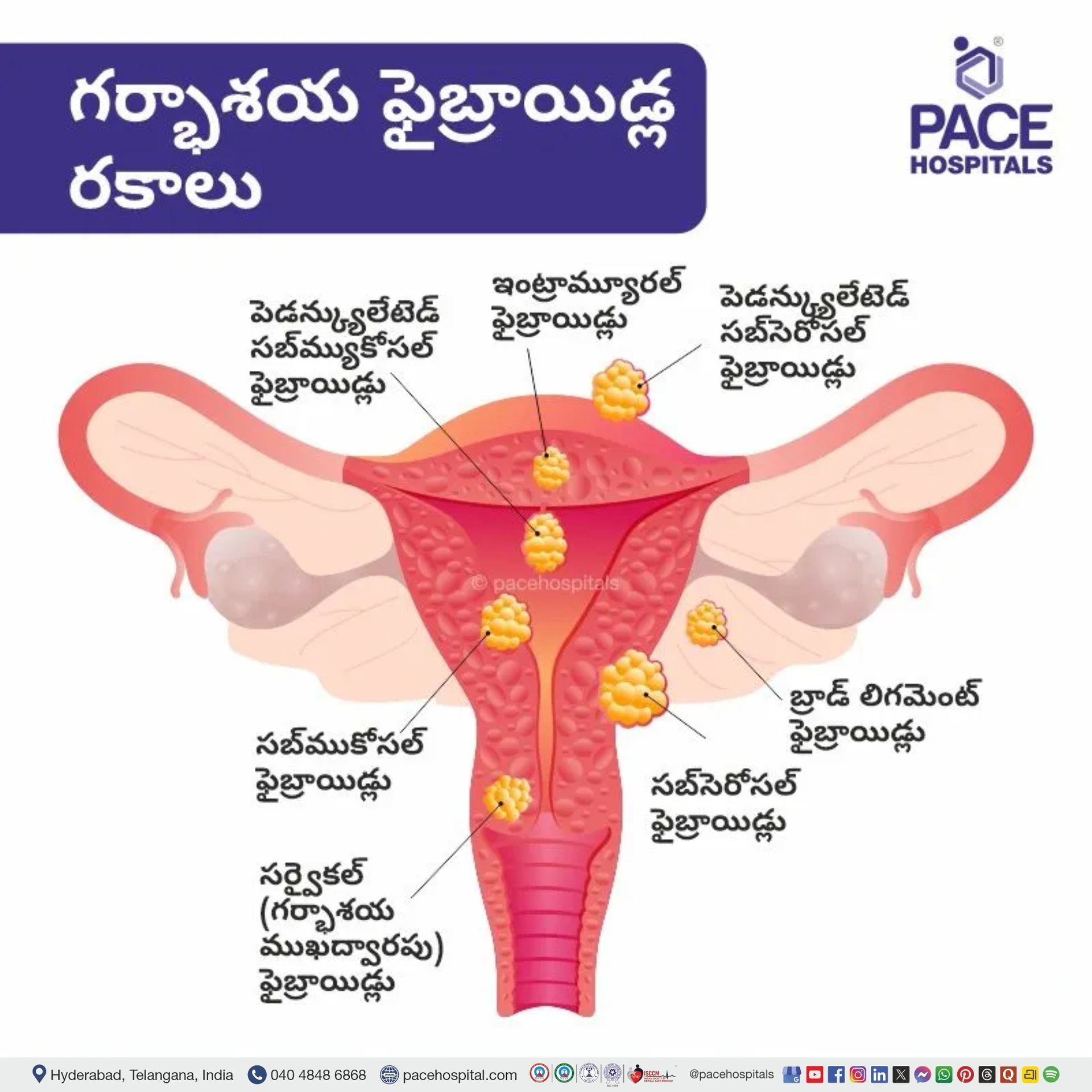 గర్భాశయ ఫైబ్రాయిడ్ల రకాలు | Types of uterine fibroids Uterine fibroids meaning in telugu | types of uterine fibroids in telugu | uterine fibroids pictures images | uterine fibroid classification in telugu | intramural uterine fibroid | subserosal uterine fibroid