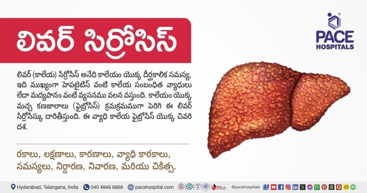 లివర్ సిర్రోసిస్ - రకాలు, లక్షణాలు, కారణాలు, వ్యాధి కారకాలు, సమస్యలు, నిర్దారణ, నివారణ, చికిత్స