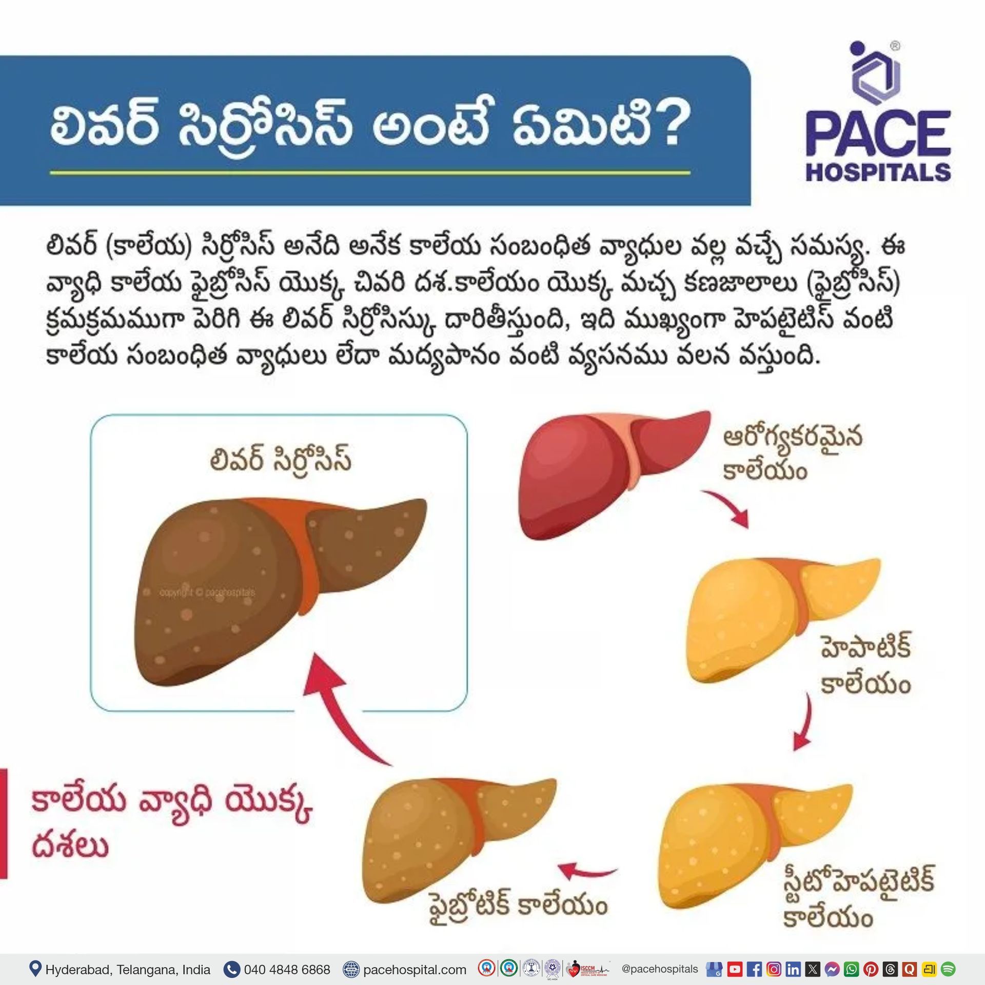 liver cirrhosis telugu | liver cirrhosis meaning in telugu | cirrhosis of liver in telugu