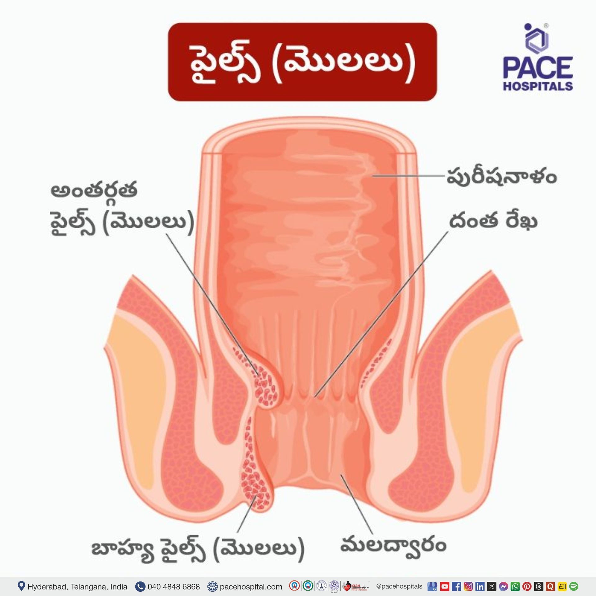 hemorrhoids (piles) meaning in telugu | hemorrhoids (piles) telugu | haemorrhoids (piles) disease in telugu | haemorrhoids in telugu