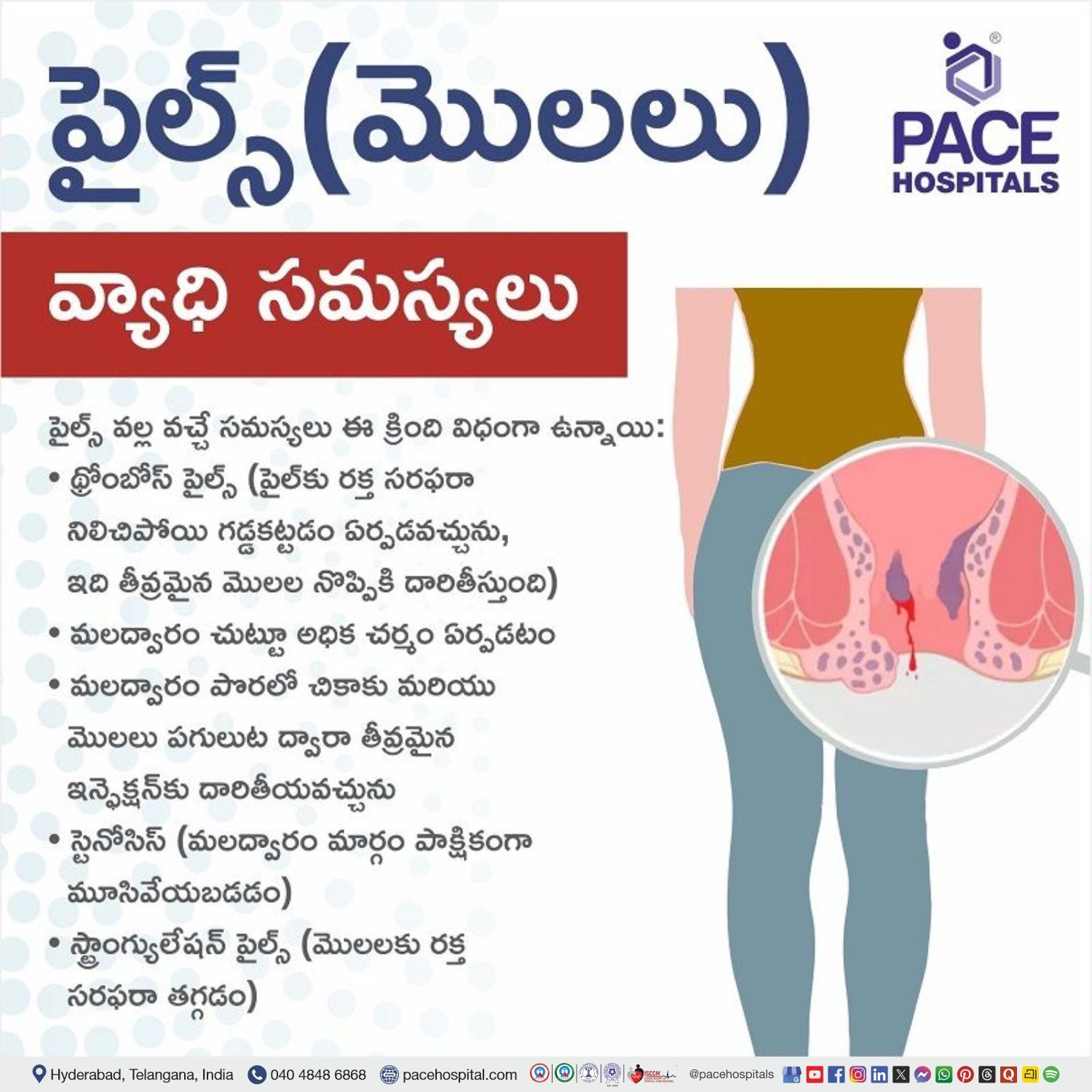 why piles will come in telugu | piles complications in telugu | complications of hemorrhoids in telugu