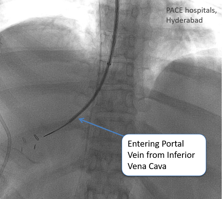 DIPS (Direct Intrahepatic Portosystemic Shunt) Procedure