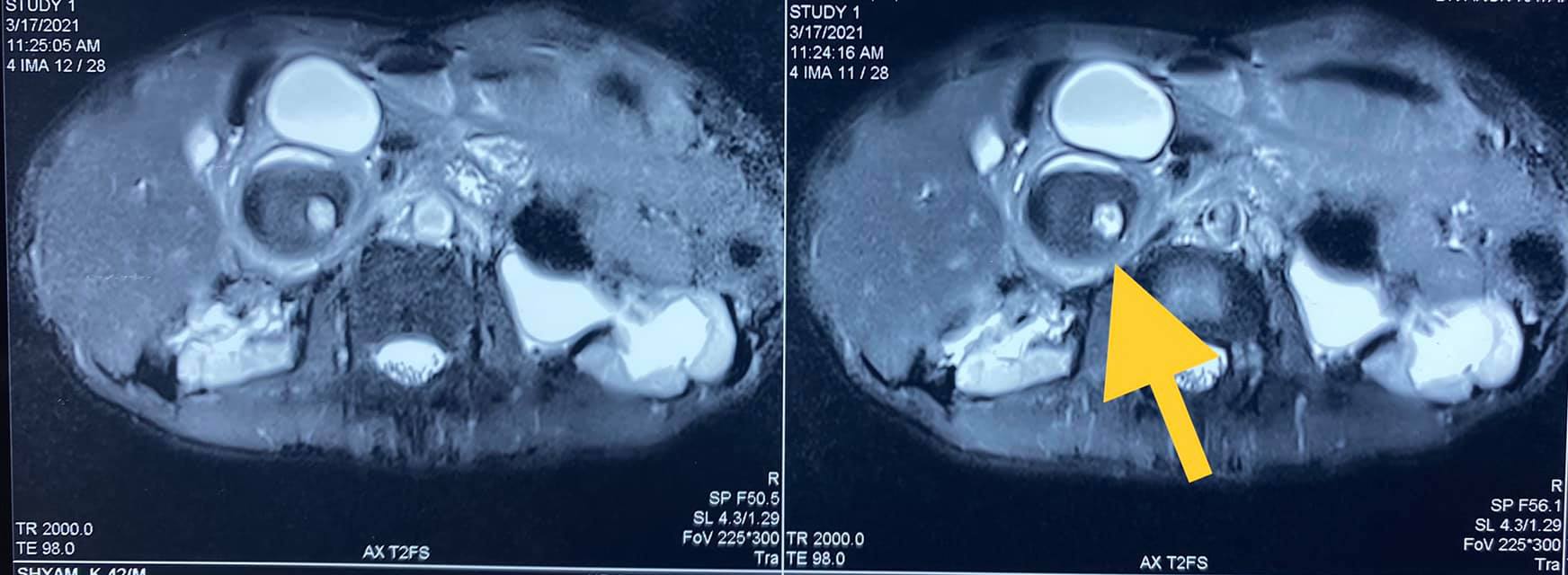 40 year old male with idiopathic chronic pancreatitis with intractable pain and sitophobia